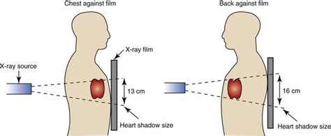 Useful physics principle of CXR – Brian's Radiology Learning Diary