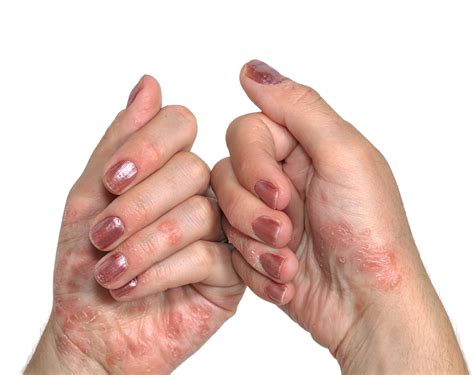 Understanding and Managing Skin Pain With Psoriasis