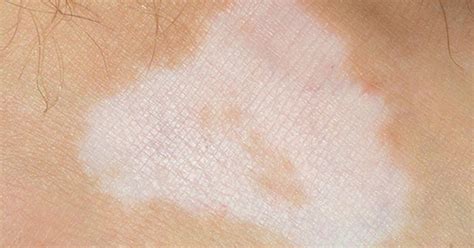 Psoriasis White Patches: What Happens to Your Skin During a Flare-Up?