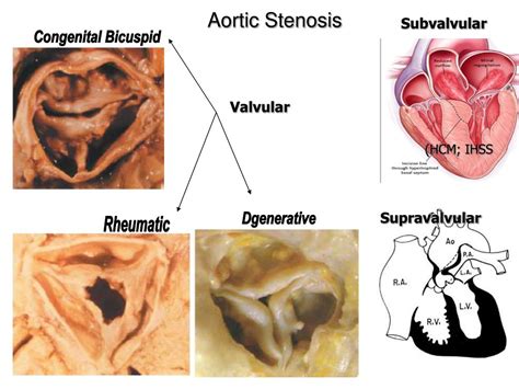 Rheumatic Aortic Valve Stenosis | Hot Sex Picture