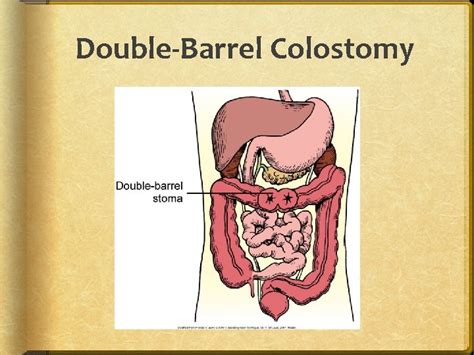 Chapter 46 Bowel Elimination Organs of the Gastrointestinal