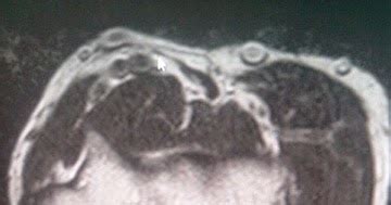 Triceps tendon tear-MRI - Sumer's Radiology Blog