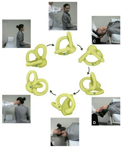 Causes Of Vertigo And Sickness | Vertigo, Doctor of physical therapy, Vertigo treatment