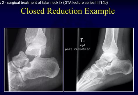 Surgical Treatment of Talar Neck fractures — OrthopaedicPrinciples.com