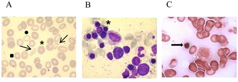 (A) Peripheral blood smear of patient 4 showing anisopoikilocytosis... | Download Scientific Diagram