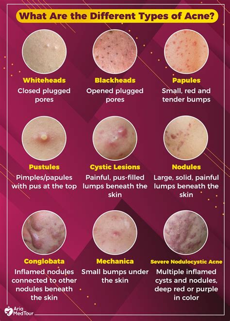 Types Of Acne Nodules