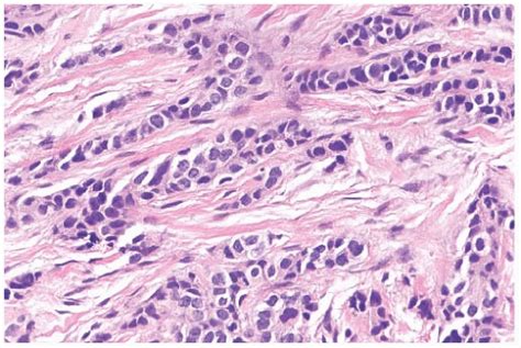 Invasive Lobular Carcinoma Image