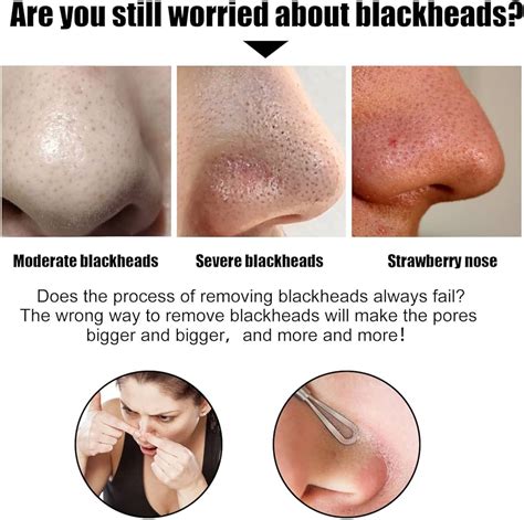 How to remove blackheads from nose