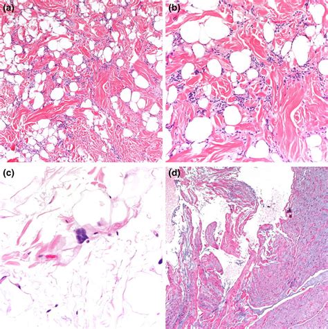 Spindle Cell Lipoma Histology