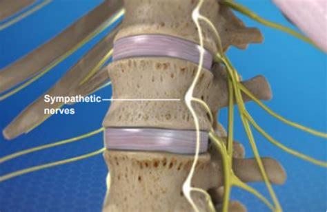 Lumbar Radiculopathy | Sciatica Pain Treatment, Texas