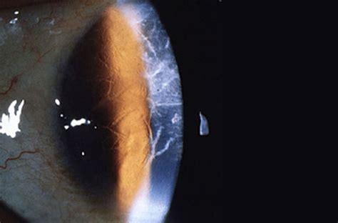 Lattice Dystrophy