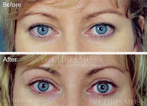 Eyelid Surgery (Blepharoplasty) Melbourne by Dr Chris Moss