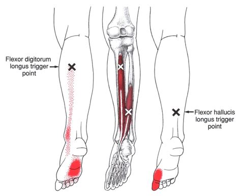 Flexor Digitorum Longus | The Trigger Point & Referred Pain Guide | Health Myofascial Release ...