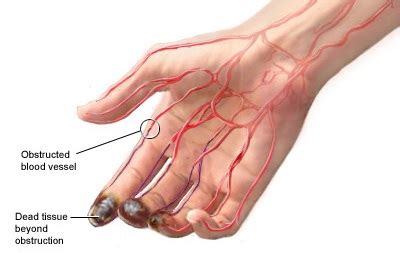 Buerger's Disease Symptoms and Treatments | New Health Advisor