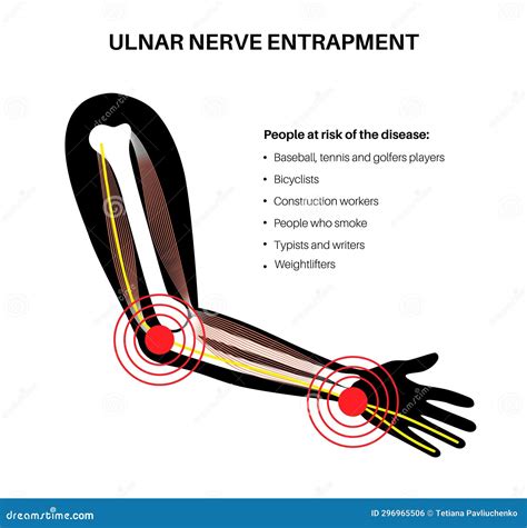 Ulnar Nerve Anatomy Cartoon Vector | CartoonDealer.com #298835671