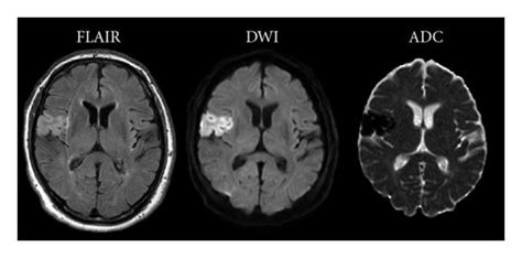 Case 2: follow-up MRI with FLAIR, DWI, and ADC showing an established... | Download Scientific ...