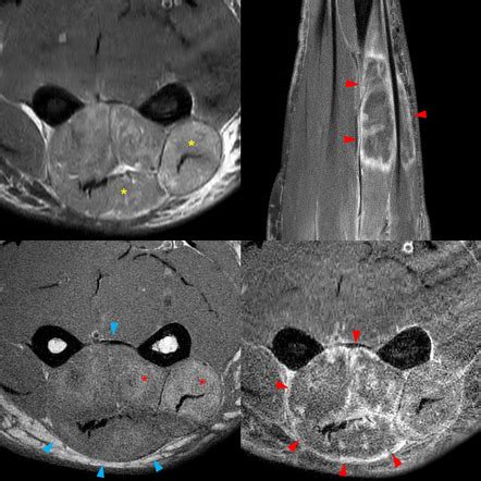 Contrast media extravasation | Radiology Reference Article | Radiopaedia.org