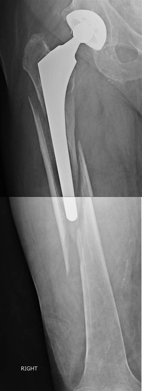 Revision THA for a severe periprosthetic hip fracture – Darwin Chen, MD