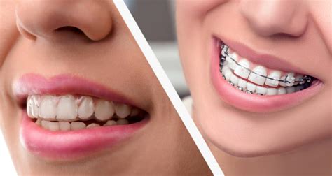 Invisalign vs. Braces : Farr West Orthodontics