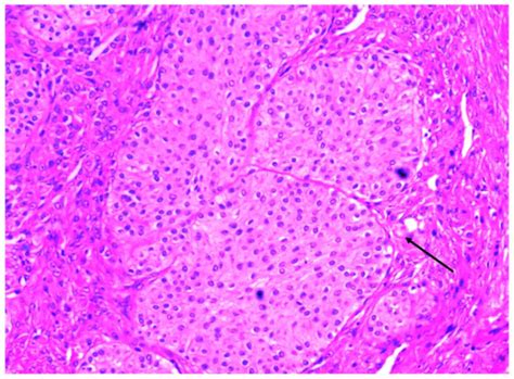 Computed tomography imaging features of benign ovarian Brenner tumors