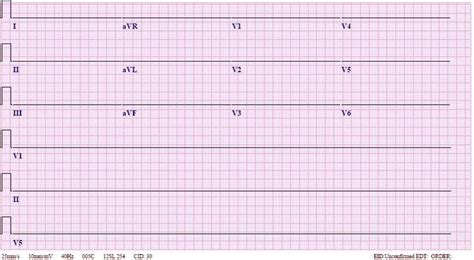 Asystole ECG Review | Learn the Heart