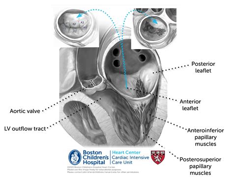 Mitral Valve Pathologies – Online supplement