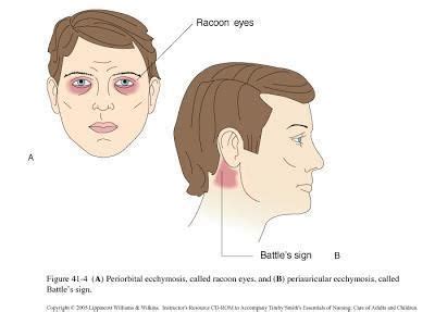 basal skull fracture sign - Bernadette Ellison