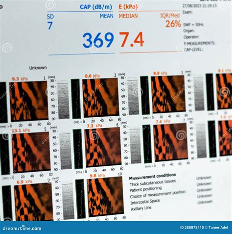 Fibroscan Examination Study Of The Liver Revealed F2 For Liver ...