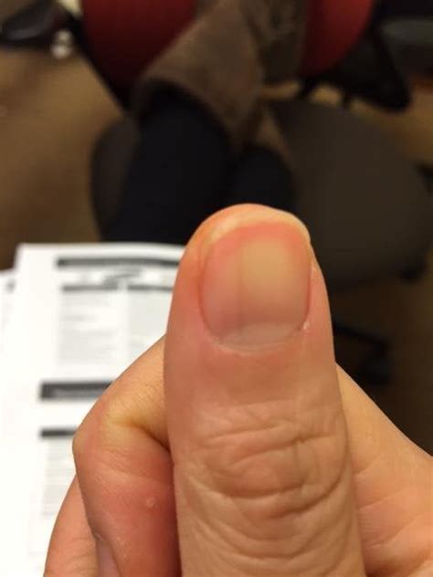 Concerned about appearance of a vertical black line on the nail of my ...