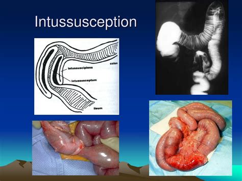 PPT - Bowel Obstruction: Infants and Children PowerPoint Presentation ...