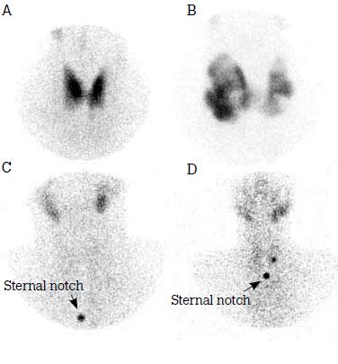 RACGP - Thyroid scans