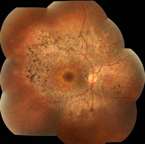 Syphilis Neuroretinopathy - Retina Image Bank