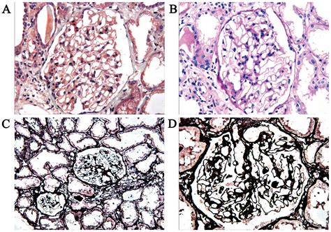 Mesothelioma Cells