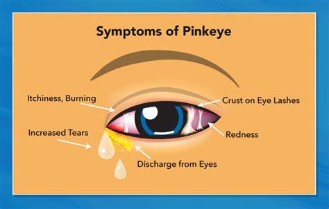 Pinkeye (Conjunctivitis) in Children