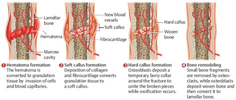 1 Physiology of Fracture Healing | Musculoskeletal Key