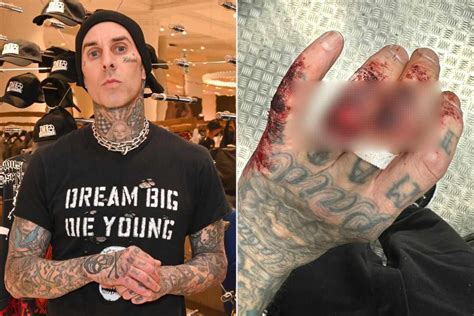 Travis Barker Displays Gory Hand Injury After Blink-182 Concert in England