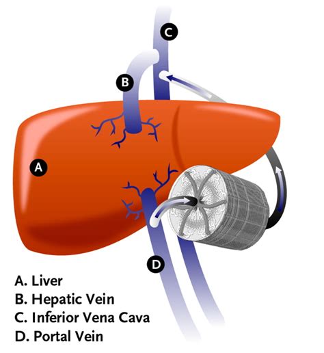 The Quest for an Artificial Liver | Livers With Life