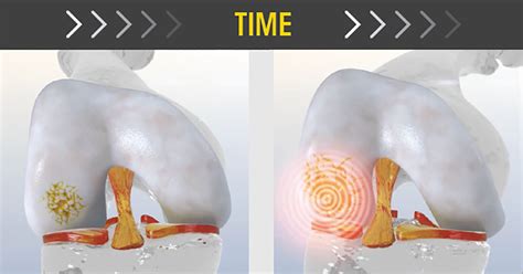 Time Matters: Why You Shouldn't Wait to Treat Your Cartilage Injury