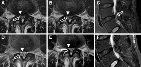 Serial magnetic resonance imaging (MRI) of spinal cyst (T 2 weighted ...