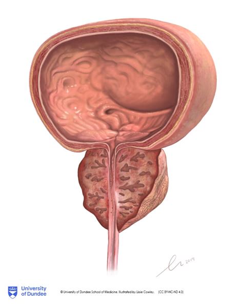 Hyperplasia: enlarged Prostate | © University of Dundee Scho… | Flickr