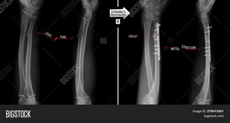 X-ray Forearm Bones. Image & Photo (Free Trial) | Bigstock