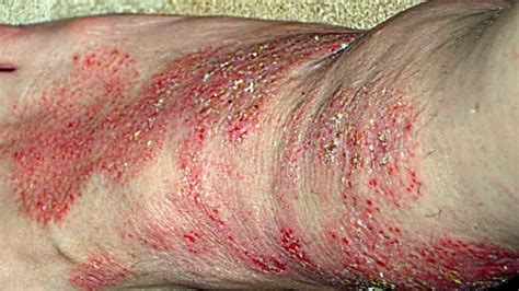 What Is Morgellons Disease? | Healthtian