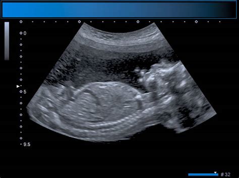 Ultrasound Twins Stock Photos, Pictures & Royalty-Free Images - iStock