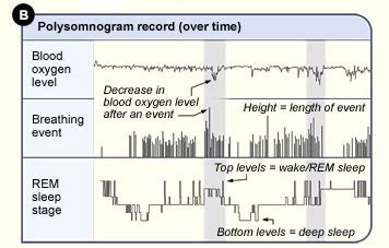 The Polysomnogram Test for Sleep Apnea