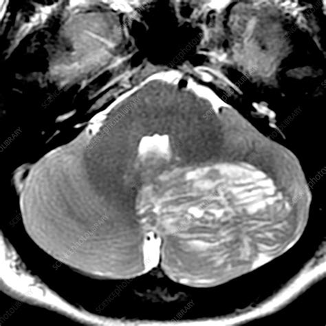 Lhermitte-Duclos Disease, MRI - Stock Image - C030/6526 - Science Photo ...