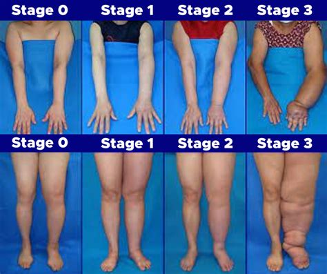 Decoding Lyphedema Stages Of Lyphedema Lymphedema Lymphedema Sexiz Pix | Sexiz Pix