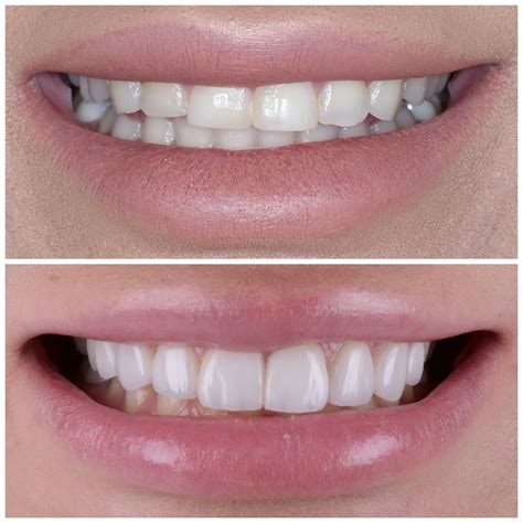 Veneers - Smile Tijuana Dentist Cosmetic & Holistic Dentistry