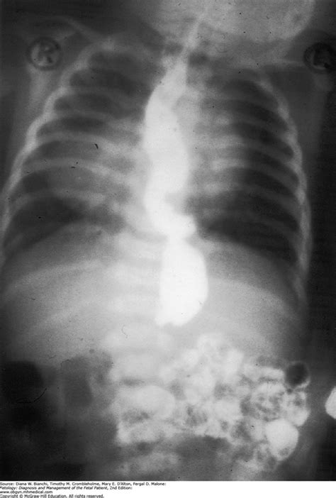 Heterotaxy Syndrome | Obgyn Key