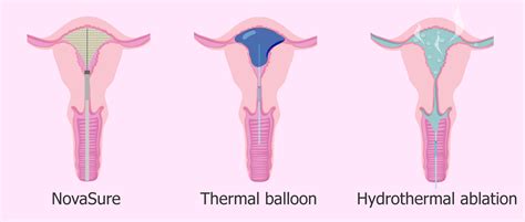 What Is Endometrial Ablation? - Procedure, Recovery & Pregnancy