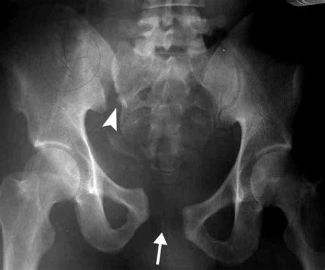 Pelvic Fractures - OrthoInfo - AAOS